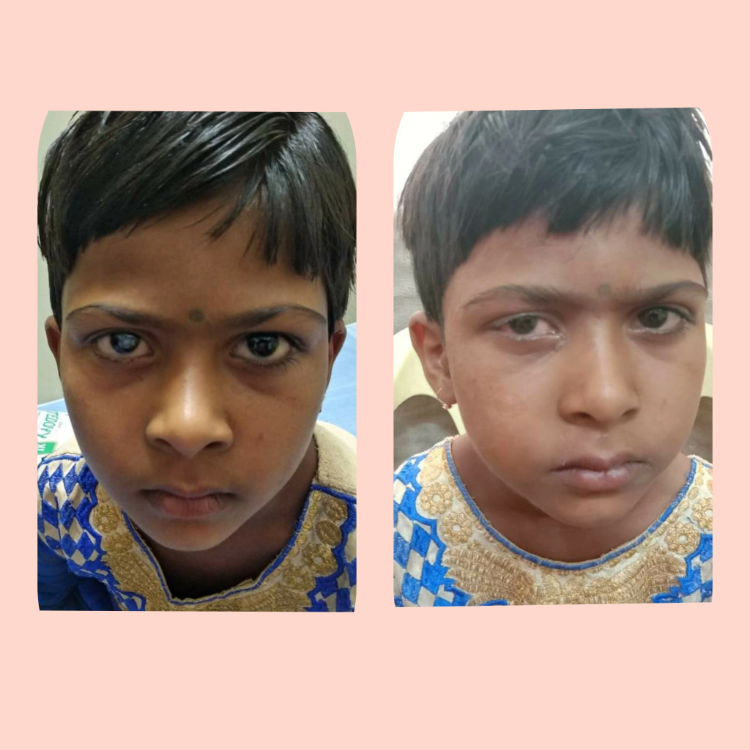 Cataract-4